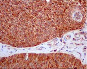 Immunohistochemical analysis of paraffin-embedded Human Transitional cell bladder carcinoma tissue labeling TSPAN17 with ab180601 at 1/100 dilution, followed by ImmunoHistoprobe (Ready to use) HRP Polymer for Rabbit IgG. Counter stained with Hematoxylin.