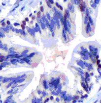 ab72876 at 1/50 dilution staining TTF1 in human lung by Immunohistochemistry, Formalin-fixed, Paraffin-embedded tissue.