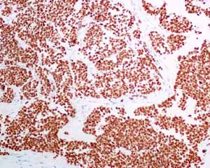 Immunohistochemical analysis using ab137061 showing positive staining in Small cell lung carcinoma tissue.