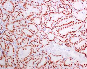 Immunohistochemical analysis using ab137061 showing positive staining in Thyroid gland papillary carcinoma tissue.