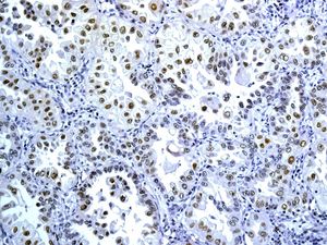 Immunohistochemical analysis of paraffin-embedded Human lung carcinoma tissue labelling TTF1 with ab137061 at 1/250 dilution.