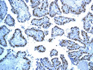 Immunohistochemical analysis of paraffin-embedded Human papillary thyroid carcinoma tissue labelling TTF1 with ab137061 at 1/250 dilution.