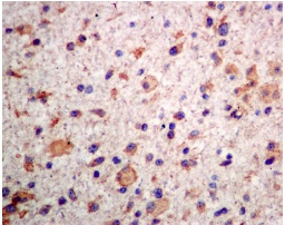 Immunohistochemical analysis of paraffin-embedded Human astrocytoma tissue labelling TUB 1 with ab131034 antibody at 1/100 dilution.