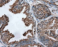 ab124030, at a 1/50 dilution, staining TUBA8 in paraffin embedded Human prostate tissue by Immunohistochemistry.