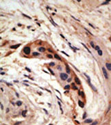 ab38551, staining SLUG in Human breast carcinoma by Immunohistochemistry, Formalin-fixed, Paraffin-embedded tissue. ab38551 was peroxidase-conjugated to the secondary antibody, followed by AEC staining.