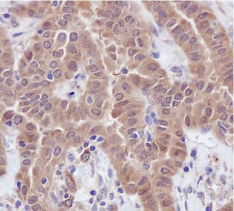 Immunohistochemical analysis of paraffin-embedded Human thyroid papillary adenocarcinoma tissue labeling TXNL1 with ab188328 at 1/250 dilution followed by pre-diluted HRP Polymer for Rabbit IgG secondary antibody and counter-stained with Hematoxylin.