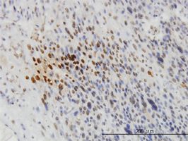 TYK2 antibody (ab57677) used in immunohistochemistry at 3ug/ml on formalin fixed and paraffin embedded human leiomyosarcoma.