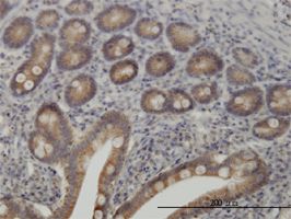 TYK2 antibody (ab57678) used in immunohistochemistry at 3ug/ml on formalin fixed and paraffin embedded human lymphoma.