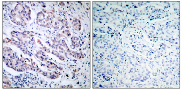 Immunohistochemical analysis of paraffin-embedded human breast carcinoma, using ab39550 (10-20µg/ml). Left: Untreated; Right: Treated with synthesized peptide.