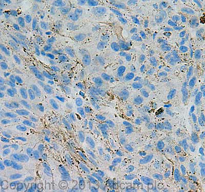 IHC image of Tyrosinase staining in Human Skin Melanoma formalin fixed paraffin embedded tissue section, performed on a Leica Bond™ system using the standard protocol F. The section was pre-treated using heat mediated antigen retrieval with sodium citrate buffer (pH6, epitope retrieval solution 1) for 20 mins. The section was then incubated with ab58450, 1 µg/ml, for 15 mins at room temperature and detected using an HRP conjugated compact polymer system. DAB was used as the chromogen. The section was then counterstained with haematoxylin and mounted with DPX. For other IHC staining systems (automated and non-automated) customers should optimize variable parameters such as antigen retrieval conditions, primary antibody concentration and antibody incubation times.