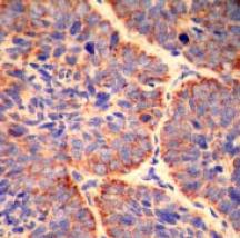 ab32023, at a 1/10 dilution, staining human Smac/Diablo in skin cancer tissue by Immunohistochemistry, Paraffin embedded tissue