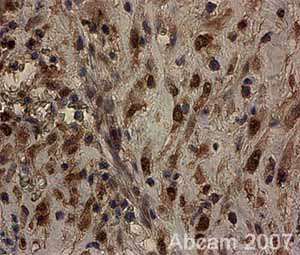 ab25837 staining human anal cancer tissue sections by IHC-P.  Sections were formaldehyde fixed and subjected to heat mediated antigen retrieval in citrate buffer (pH 6) prior to blocking with 5% serum for 45 mins at 22°C.  The primary antibody was diluted 1/200 and also incubated with the section for 45 mins at 22°C.  A HRP-conjugated goat anti-rabbit was used as the secondary antibody.See Abreview