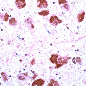 ab7780 (1/100) staining Ubiquitin in paraffin-embedded brain sections of a patient with Alzheimer's disease.