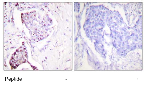 Ab58453 at 1/50-1/100 dilution staining human breast carcinoma tissue without and with blocking peptide; paraffin embedded.