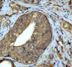 ab33893 at a 1:250 dilution staining Ubiquitin in human prostate adenocarcinoma using Immunohistochemistry, Paraffin Embedded Tissue.