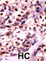 Ab60221 (1:50) staining human UCK2 in human hepatocarcinoma tissue by immunohistochemistry using formalin fixed, paraffin embedded tissue. Formalin-fixed and paraffin-embedded human cancer tissue reacted with the primary antibody, which was peroxidase-conjugated to the secondary antibody, followed by AEC staining. HC = hepatocarcinoma
