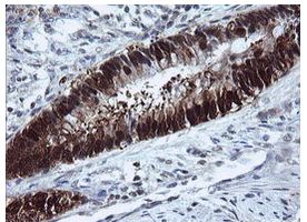 Immunohistochemical analysis of paraffin-embedded Human colon adenocarcinoma tissue labelling UMP/CMP kinase with ab139355 at 1/150 dilution.