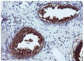 Immunohistochemical analysis of paraffin-embedded Human prostate carcinoma tissue labelling UMP/CMP kinase with ab139355 at 1/150 dilution.