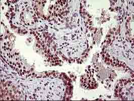 Immunohistochemical analysis of paraffin-embedded Carcinoma of Human prostate tissue labeling UPRT with ab180382 at 1/150 dilution.