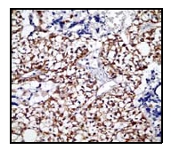 Immunohistochemical analysis of Smad3 in paraffin embedded human liver carcinoma tissue using ab52903 at 1/100 dilution.Immunohistochemical analysis of Smad3 in paraffin embedded human liver carcinoma tissue using ab52903 at 1/100 dilution.