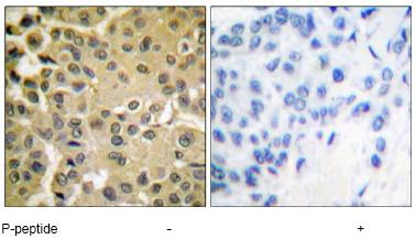 Ab47439, at dilution of 1/50, staining Smad3 in paraffin embedded human breast carcinoma tissue by Immunohistochemistry. Left image: No peptide. Right image: Phosphopeptide present.