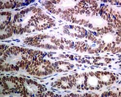 Immunohistochemical analysis of paraffin-embedded Human colonic adenocarcinoma tissue labelling USP39 with ab131244 at 1/100 dilution.
