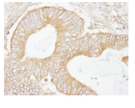 ab84695, at 1/100 dilution, staining USP5 in formalin-fixed, paraffin-embedded human colon carcinoma by Immunohistochemistry using DAB staining.
