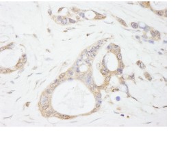 ab84695, at 1/500 dilution, staining USP5 in formalin-fixed, paraffin-embedded human ovarian carcinoma by Immunohistochemistry using DAB staining.