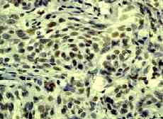 Ab45150 staining human v-Myb / c-Myb in human cervical carcinoma by immunohistochemistry using paraffin embedded tissue.