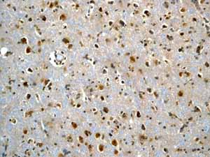 Immunohistochemistry (Formalin/PFA-fixed paraffin-embedded sections) analysis of human glioma tissue labelling unpurified ab40854.