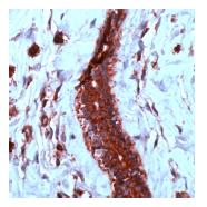 Human angiosarcoma stained with ab39250.
