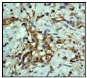 Ab52917 (1:50) staining human VEGF in human hemangioma tissue by immunohistochemistry using paraffin embedded tissue.Ab52917 (1:50) staining human VEGF in human hemangioma tissue by immunohistochemistry using paraffin embedded tissue.