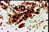 ab2350 - immunohistochemistry Formalin fixed paraffin embedded human angiosarcoma stained with VEGF Receptor 1, using ABC and AEC chromogen.