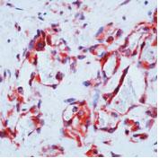 Formalin-fixed, paraffin-embedded human angiosarcoma stained with ab80838, at 5 -10 &microg/ml, using a peroxidase-conjugated secondary and AEC chromogen. Note cytoplasmic staining of tumor cells.  This image was produced using another version of this antibody, containg BSA and azide.