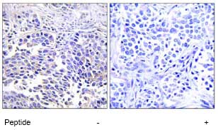 Immunohistochemical analysis of VGF in paraffin embedded human lung carcinoma tissue using ab74140, at a 1/50 dilution, in the presence (right panel) or absence (left panel) of immunising peptide.