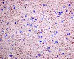 Immunohistochemical analysis of paraffin-embedded Human glioma tissue labeling VILIP1 with ab151741 at 1/100 dilution.