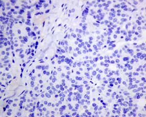 Immunohistochemical analysis of paraffin embedded Human Thyroid gland carcinoma tissue using ab151741 showing -ve staining.