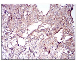 Immunohistochemical analysis of paraffin embedded Human stomach cancer tissue labeling Villin using ab202021 at 1/200 dilution, followed by DAB staining.