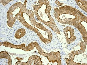 Immunohistochemical analysis of paraffin-embedded Human colon adenocarcinoma tissue labelling Villin with ab133510 at 1/100 dilution.
