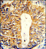 Immunohistochemical analysis of formalin-fixed, paraffin-embedded Human colon carcinoma tissue labelling Villin with ab135608 at 1/50 dilution followed by peroxidase-conjugated secondary antibody and DAB staining.