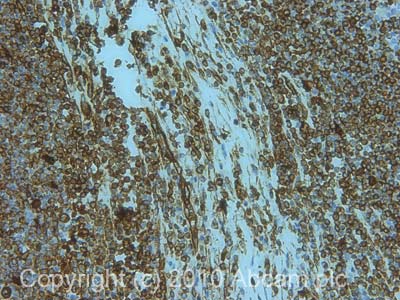 IHC image of Vimentin staining in human Hodgkin's Lymphoma formalin fixed paraffin embedded tissue section, performed on a Leica BondTM system using the standard protocol F. The section was pre-treated using heat mediated antigen retrieval with sodium citrate buffer (pH6, epitope retrieval solution 1) for 20 mins. The section was then incubated with ab8069, 1µg/ml, for 15 mins at room temperature and detected using an HRP conjugated compact polymer system. DAB was used as the chromogen. The section was then counterstained with haematoxylin and mounted with DPX