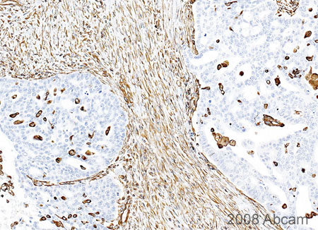 Immunohistochemical detection (formaldehyde/paraffin-embedded sections) of vimentin protein using vimentin antibody - Neural Stem Cell Marker (ab45939) on human ovarian carcinoma sections. Antigen retrieval step:Heat mediated. Blocking step: 1% BSA for 10 mins at RT°C. Ab45939 was used at 1/700 for 1 hour. Secondary Antibody: Biotin-conjugated anti rabbit IG (1/300). 