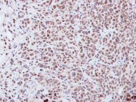 Immunohistochemical analysis of paraffin-embedded Human DLD-1 xenograft tissue labeling Vitamin D receptor, using ab137371 at a 1/500 dilution.