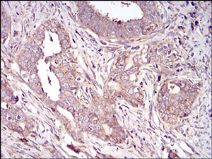 Immunohistochemical analysis of paraffin-embedded Human cervical cancer tissue labeling Vitronectin with ab201981 at 1/200 dilution with DAB staining.