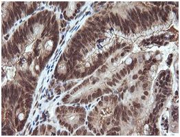 Immunohistochemical analysis of paraffin embedded adenocarcinoma of Human colon tissue labeling Von Hippel Lindau with ab140989 at a 1/150 dilution.