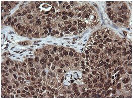 Immunohistochemical analysis of paraffin embedded carcinoma of Human lung tissue labeling Von Hippel Lindau with ab140989 at a 1/150 dilution.