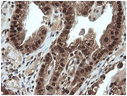 Immunohistochemical analysis of paraffin embedded adenocarcinoma of Human ovary tissue labeling Von Hippel Lindau with ab140989 at a 1/150 dilution.