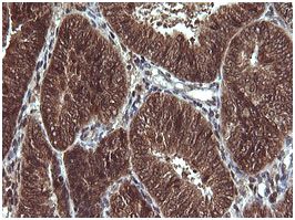 Immunohistochemical analysis of paraffin embedded adenocarcinoma of Human endometrium tissue labeling Von Hippel Lindau with ab140989 at a 1/150 dilution.