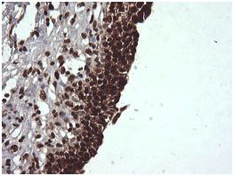 Immunohistochemical analysis of paraffin embedded adenocarcinoma of Human bladder tissue labeling Von Hippel Lindau with ab140989 at a 1/150 dilution.