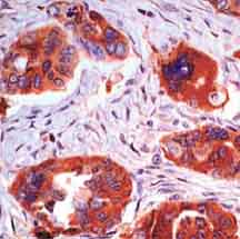 Human ovarian carcinoma stained with ab17768.